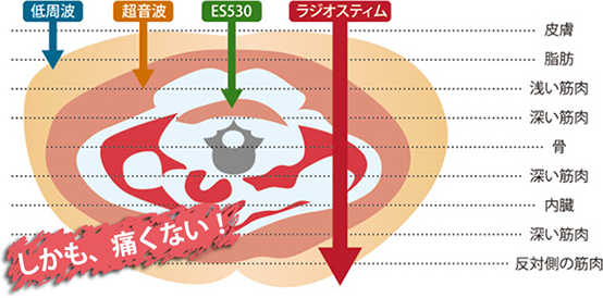 ラジオスティムなら痛みなく深部のコリ・内臓に施術できる